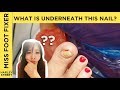 TOE HOLE | Toenail Cleaning and Rams horn nail cutting by Miss Foot Fixer Marion Yau