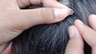 old lady hairs full of lices removal of thousands of lices by hans#ASMRSajida