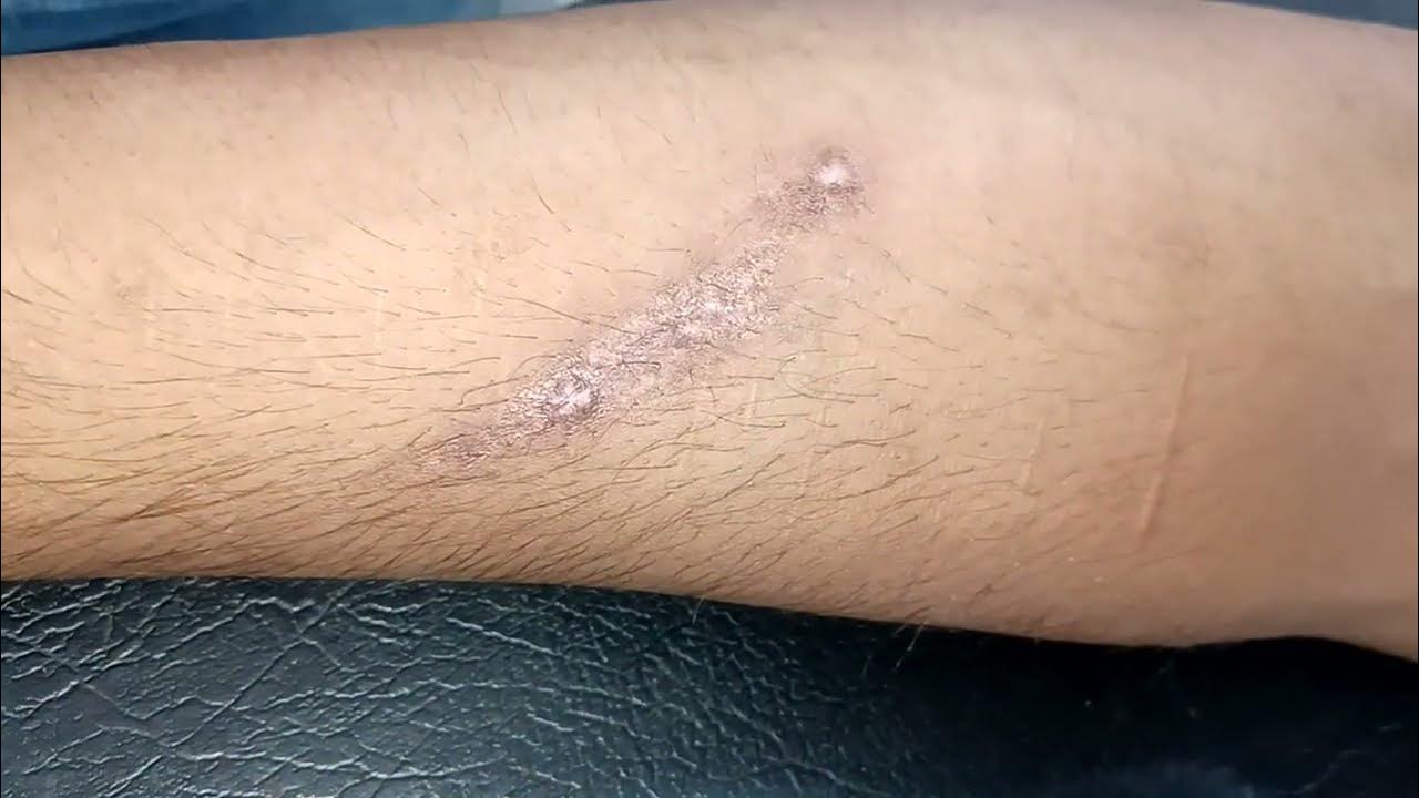 Blade Cut Marks Removal Treatment Arms Cut Marks Removal YouTube