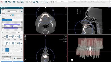 Tooth Movements with Shape Memory Aligners