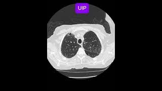 Usual interstitial pneumonia (UIP)