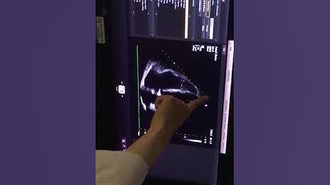 Thực hành siêu âm tim - Đo đạc các chỉ số | BV Bạch Mai 2023