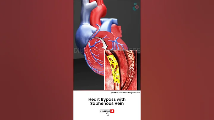 How Does Heart Bypass Surgery Work? ↪ 3D Medical Animation #Shorts #SaphenousVein