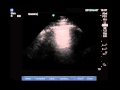 Lung ultrasound protocol for icu