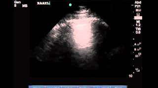 Lung Ultrasound Protocol for ICU