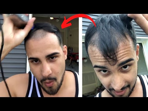 balding-at-30-"i'm-just-over-it!"---shaving-my-head-and-hair-loss-story