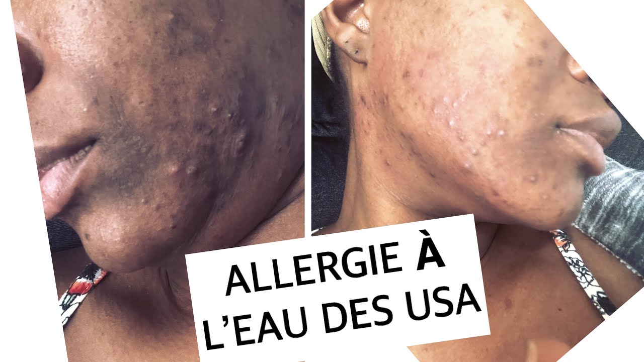 ALLERGIE À L’EAU DES JE GÈRE MON ACNÉ // MA ROUTINE