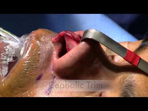 Video thumbnail: Cephalic Trim · Dr. Philip Miller, MD, FACS
