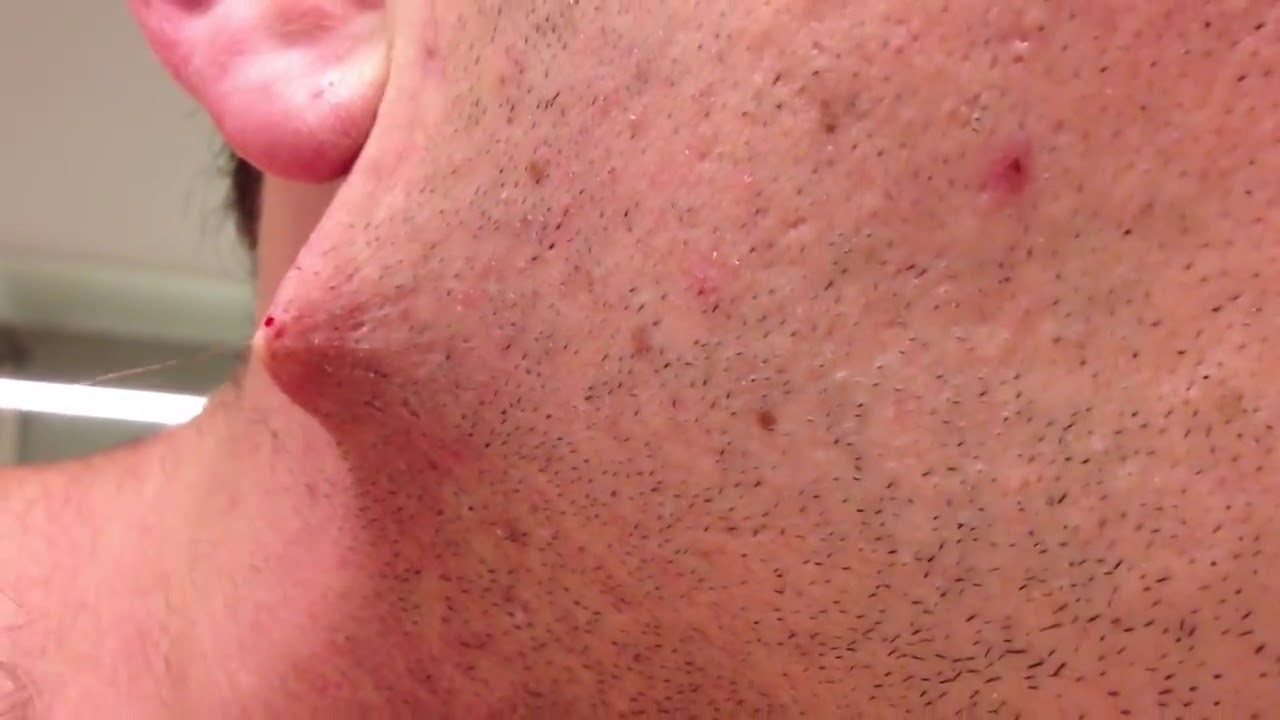 Longest Grossest Ingrown Hair The Longest Ingrown Hair In The