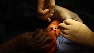 Carpal Ganglion Cyst Excision screenshot 5