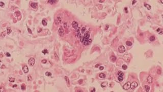 Ohio Department of Health reports state's first measles case of 2025