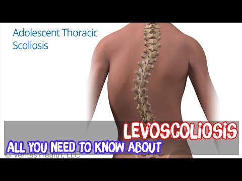 All you need to know about levoscoliosis