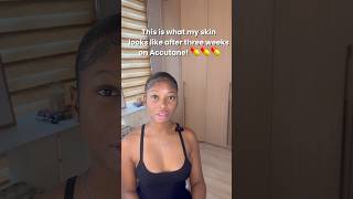 #skincareroutine #skincare Week3 on Accutane