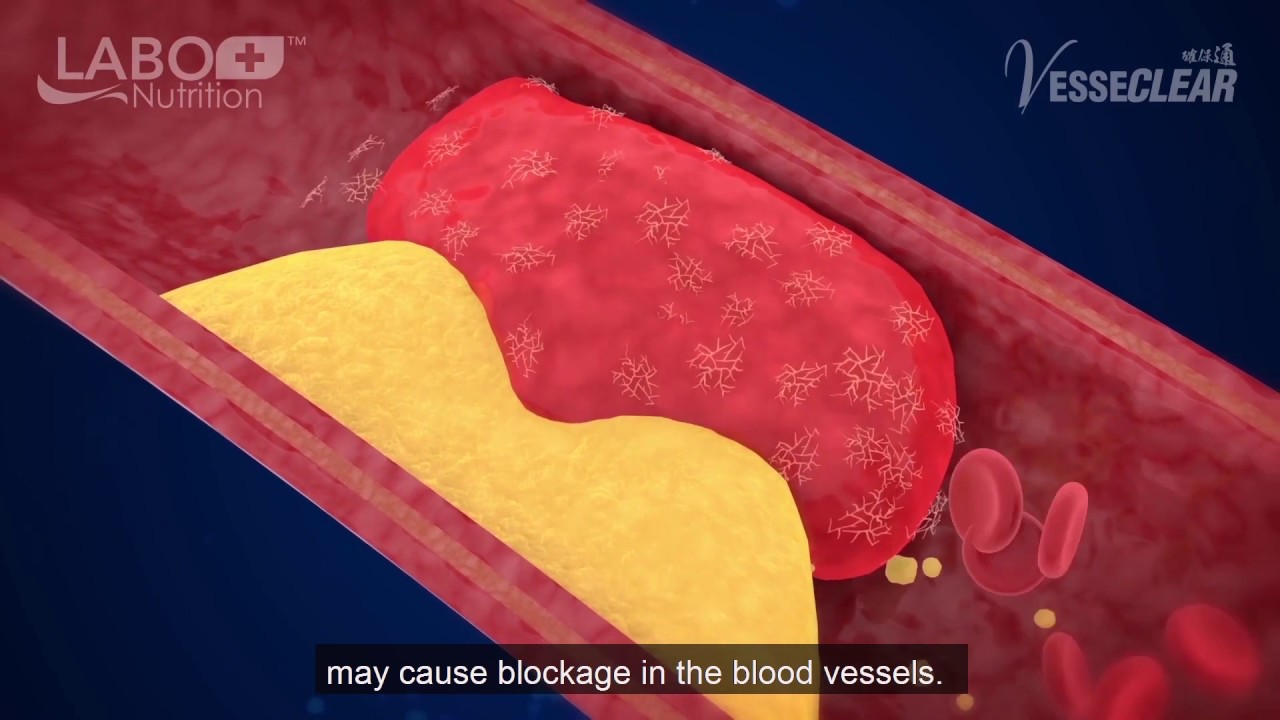 [Heart Health] Blood clot may cause stroke and even a paralysis (english, P4) YouTube