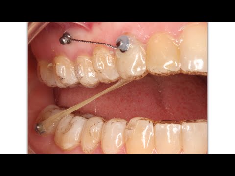 INVISALIGN: Claves para