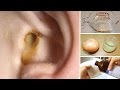 Ever Heard Of Swimmer S Ear Ever Heard Of Swimmer S Ear