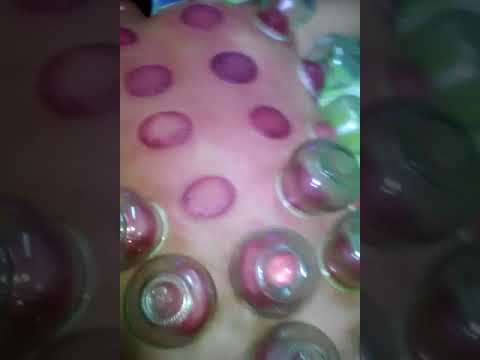 Video Bản sao của Giác hơi tại nhà | Giác hơi ấn huyệt xoa... - youtube