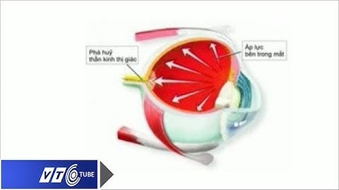 Bệnh Glôcôm: Chớ coi thường | VTC