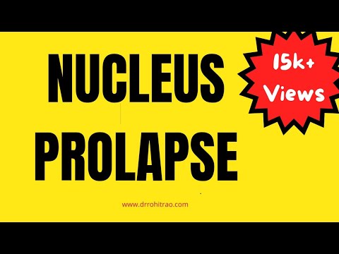 5 How To Prolapse Nucleus !!!! By Dr Rohit Rao