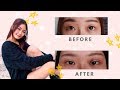 DST | Non Invasive Double Eyelid Procedure @MEClinic | Recovery Process