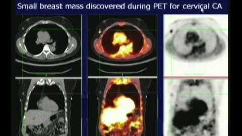 PET CT Scan