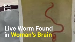 Doctors Find Live Worm in Woman's Brain