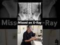 One Missed Sacral Injury Changed Her Entire Spine