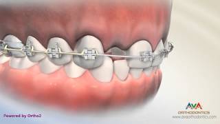 Orthodontic & Restorative Treatment For Missing Lateral Incisor - Different Options