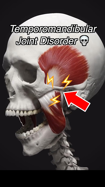 Temporomandibular Joint Dysfunction (TMJ   TMD)