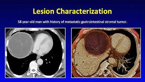 Cinematic Rendering – Liver and Pancreatic Applications