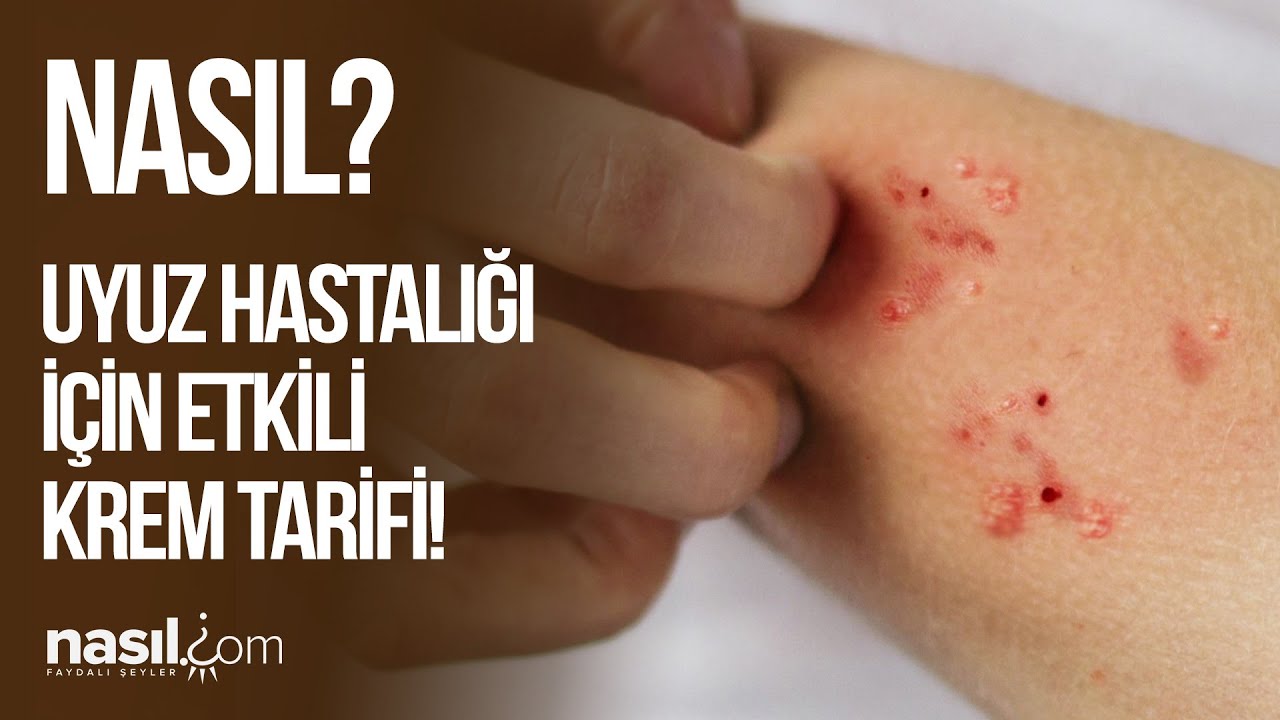 UYUZ HASTALIĞI İÇİN DOĞAL TEDAVİ! EVDE UYUZ KREMİ TARİFİ! #uyuz #