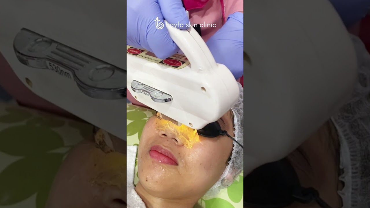 Treatment IPL rejuve bikin wajahmu  beneran auto glowing dan mencerahkan kulit wajah.