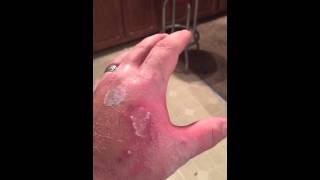 Keurig MINI Recall due to BURNS!!!!  Ouchhhhhh!!!!!