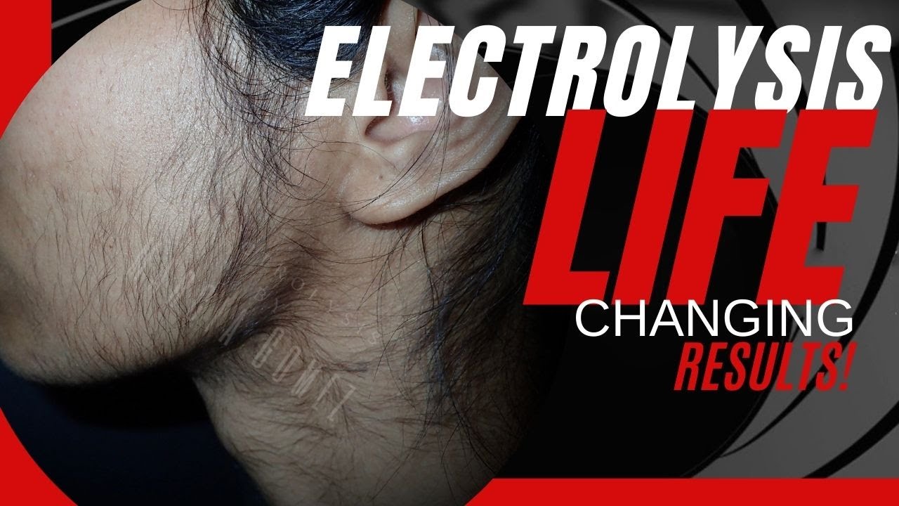 Electrolysis Hair Removal on Indian skin [PCOS] YouTube