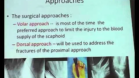 wrist fractures   Dr   Mohamed Gamal 2