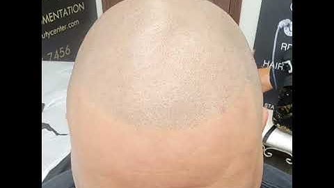 SCALP MICROPIGMENTATION  / ANTONIO BAROQUE