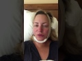 Mommy makeover facelift neck lift lipo 48 hours post surgery