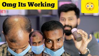 Fix bald Instantly | No side effect | Tamil | English Subtitles | Hair fibre | Shadhik Azeez