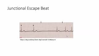 Junctional escape beat