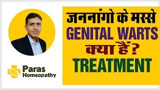 जननांगों के मस्से | GENITAL WARTS| CONDYLOMA | ANOGENITAL WARTS| Homeopathic medicine for warts