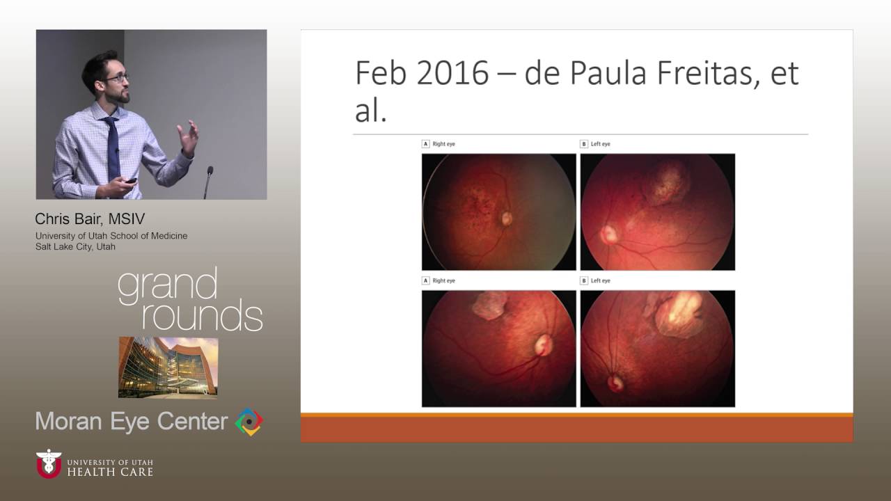 http://clinicaltrials.gov The Ocular Manifestations of Zika Virus: What We Know So Far