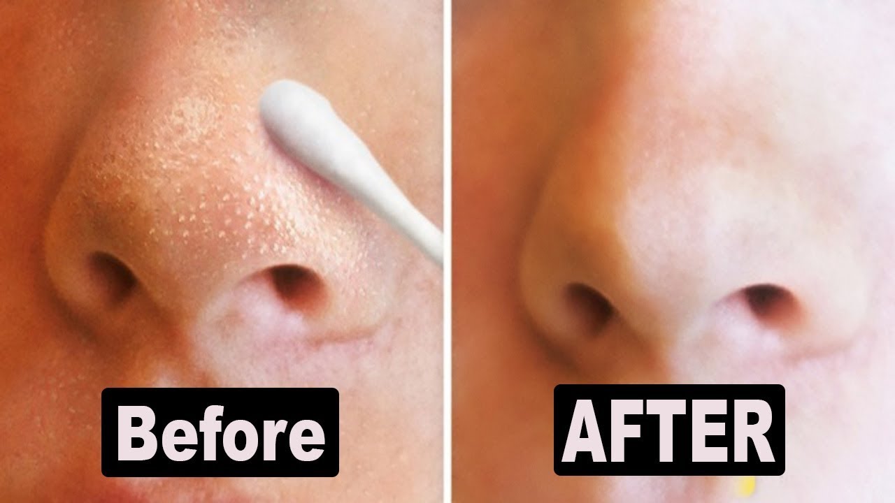 9 Natural Ways to Get Rid of Blackheads and Whiteheads Fast 2017 