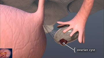 Ovarian Cysts 3D Animation | Ovarian Cysts Causes & Treatment |
