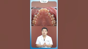 Kéo 2 Răng Ngầm Trong Xương Hàm Khi Niềng Răng | Nha Khoa Minh Châu