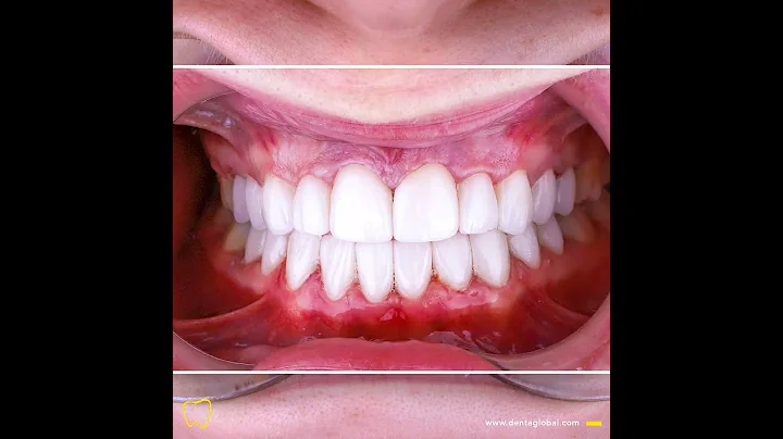 B/A Series #49 Check out this amazing new smile makeover! 🤩🦷