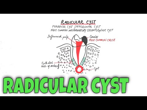 Videó: Mi az a radikuláris ciszta?