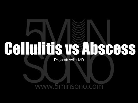 Differentiating Cellulitis from Abscess with POCUS