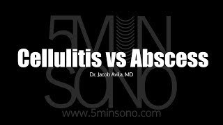 Differentiating Cellulitis from Abscess with POCUS