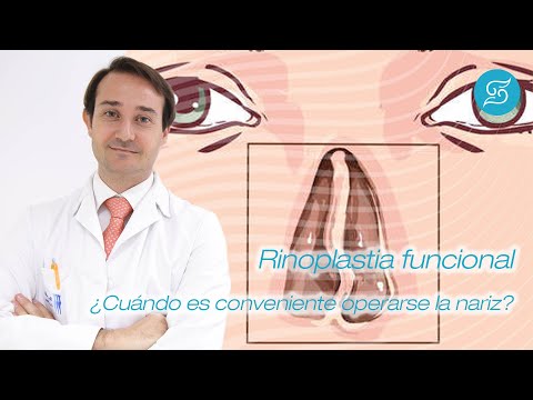 Rinopastia funcional Alicante Solesio clinic