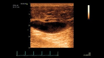 Stagnant Jugular Vein Blood Flow In Space
